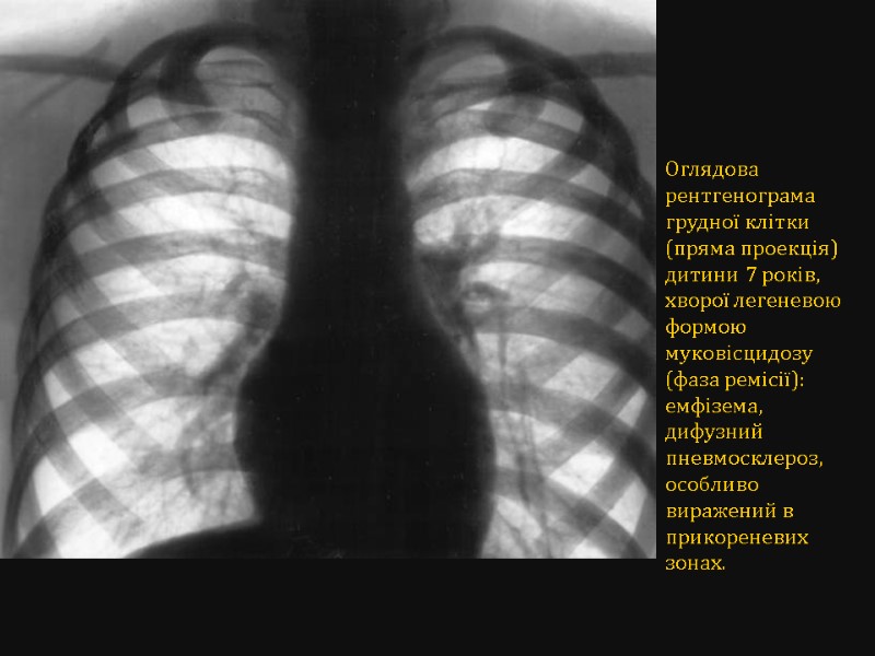 Оглядова рентгенограма грудної клітки (пряма проекція) дитини 7 років, хворої легеневою формою муковісцидозу (фаза